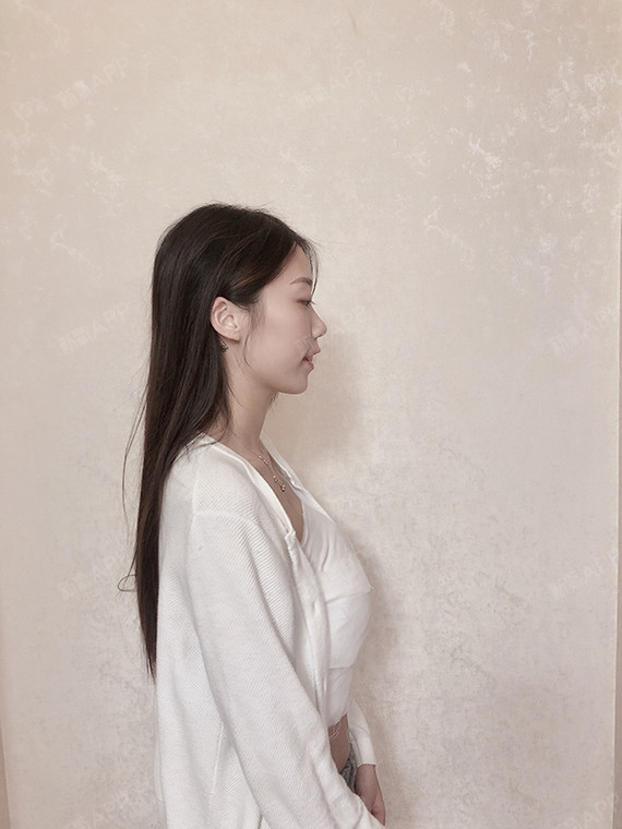 假体隆胸隆胸方案:曼托毛面圆形225cc乳晕切口手术时长:一小时40分钟