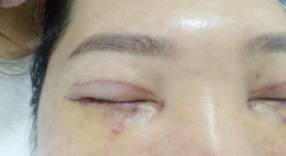 今天来医院给眼睛拆线,伤口缝合用的是非常细的美容线_圈子-新氧美容