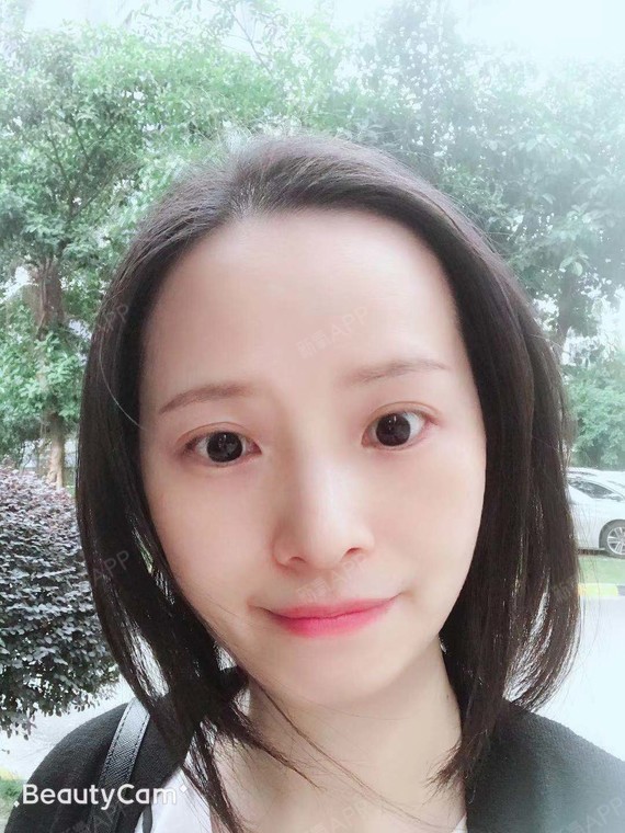 激光祛斑好不好_效果图_立志改变寄几激光祛