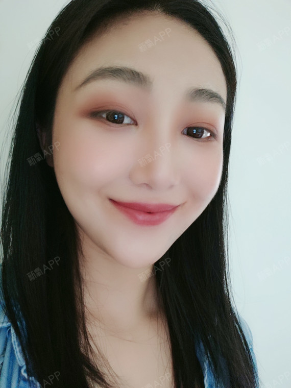 自体脂肪丰唇好不好_效果图_咪鲁咪洛花自体脂肪丰唇术后第45天_新氧