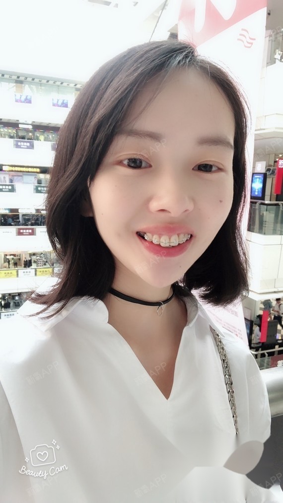 从初中开始都想戴牙套,羡慕那些一口整整齐齐牙齿的,_圈子-新氧美容
