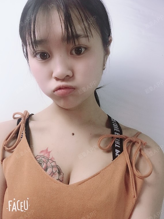 杭州艺星假体隆胸术后280天