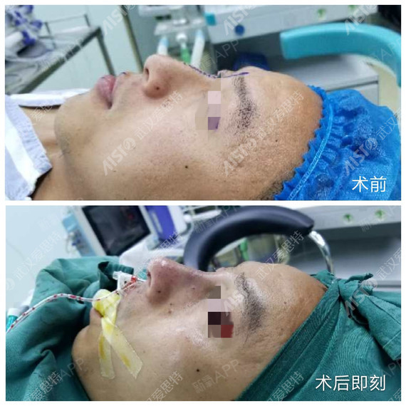 首页 此页面仅支持预览 Avatar 杨水斌 644篇日记 机构 武汉爱思特医疗美容医院 暂无评分 2359预约 鼻梁骨弯曲矫正手术效果怎样 鼻子 比脸的别的构造向前方突出 所以容易受外伤 弯鼻不仅损毁了我们的形像 也对鼻子的生理功能造成了严重的不便 鼻梁骨