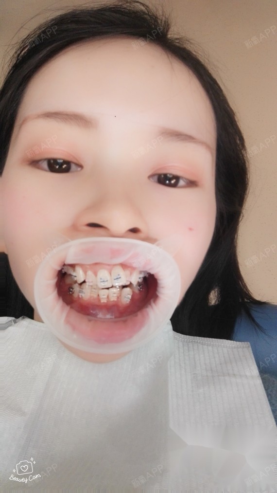 从初中开始都想戴牙套,羡慕那些一口整整齐齐牙齿的,_圈子-新氧美容