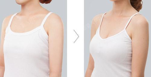 被发现隆胸后,男人竟是这样的反应!