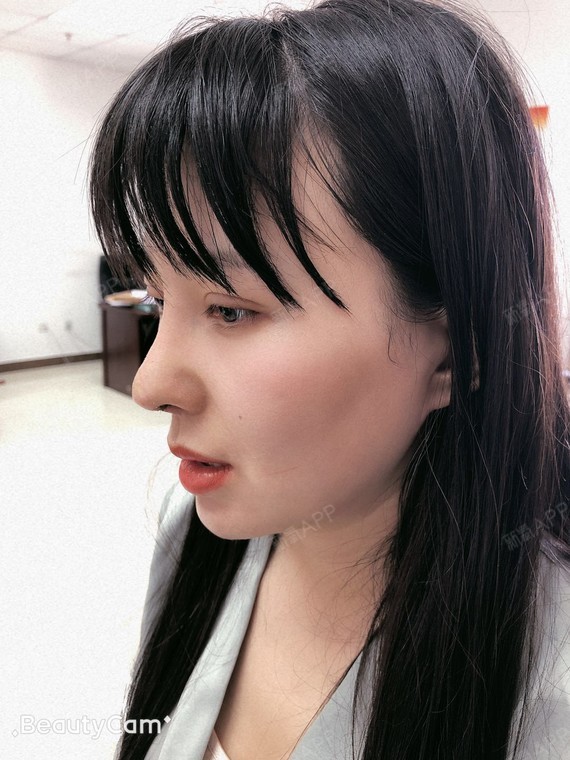 【北京美诗沁上眼睑综合媚眼术术后15天】半个月的时_圈子-新氧美容