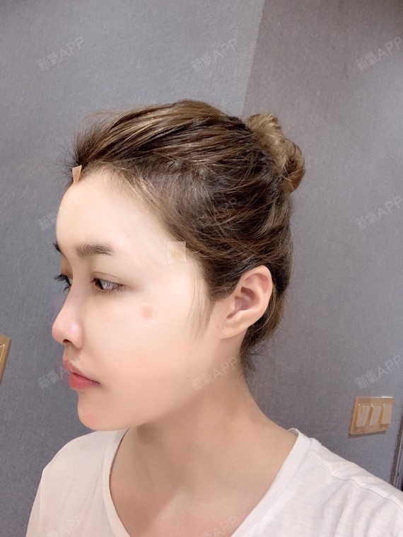 我就很喜欢这种微调方_圈子-新氧美容整形