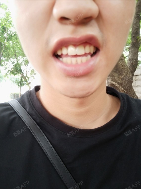 俊青 门牙缝一直困扰着我二十余年,相信有过牙缝的_圈子-新氧美容