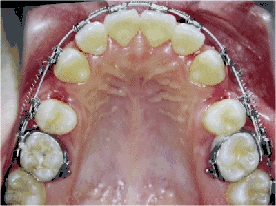 矫正打支抗钉,你怕了?