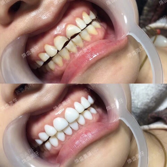 牙贴面 超瓷贴面 牙齿美白完成✅南京来的宝宝 说我_圈子-新氧美容