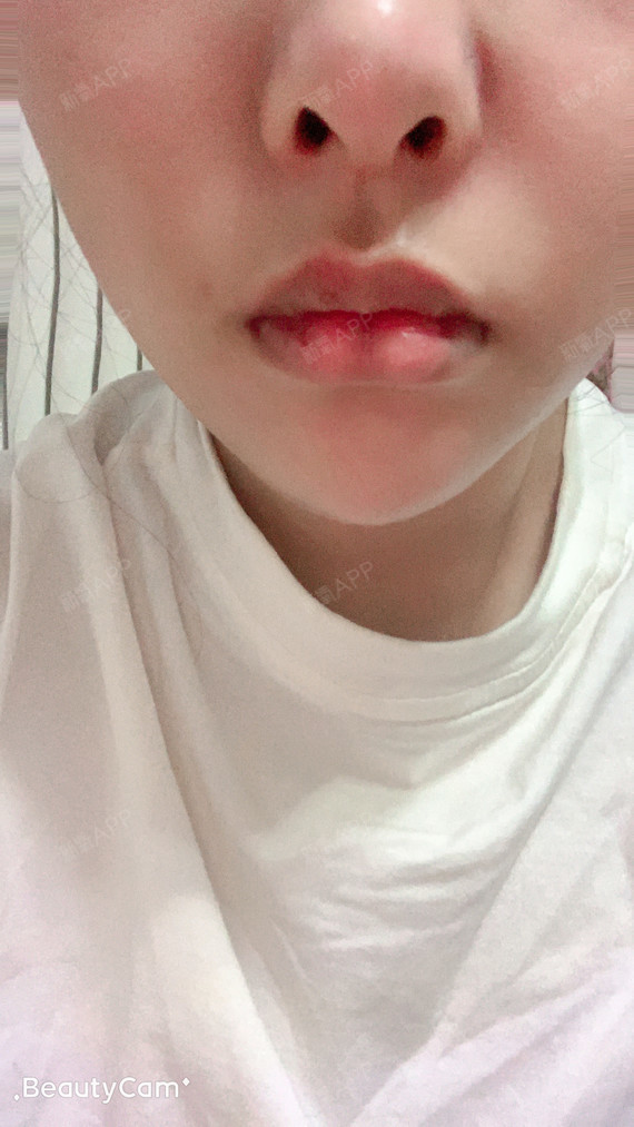 m唇手术好不好_效果图_氧气ssye79bm唇手术术后第7天_新氧美容整形