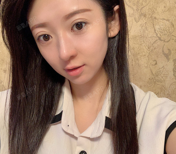 自体脂肪全脸填充好不好_效果图_氧气25zrw自体脂肪全脸填充术后第4天