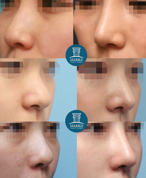 手术之前最终设计鼻型详细讲解手术方案