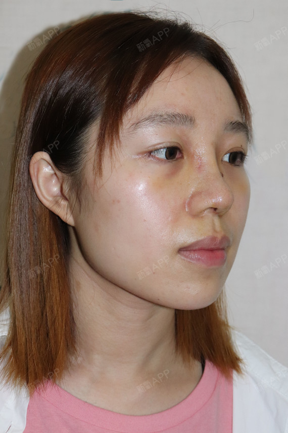 通过新氧消费方案查看鼻部多项手术中度疼痛鼻根提升机构查看成都军大