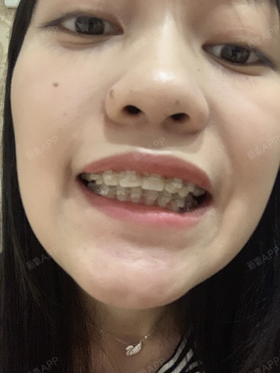 今天9-9 要死 我发现我的左边上面三号牙侧面好像_圈子-新氧美容整形