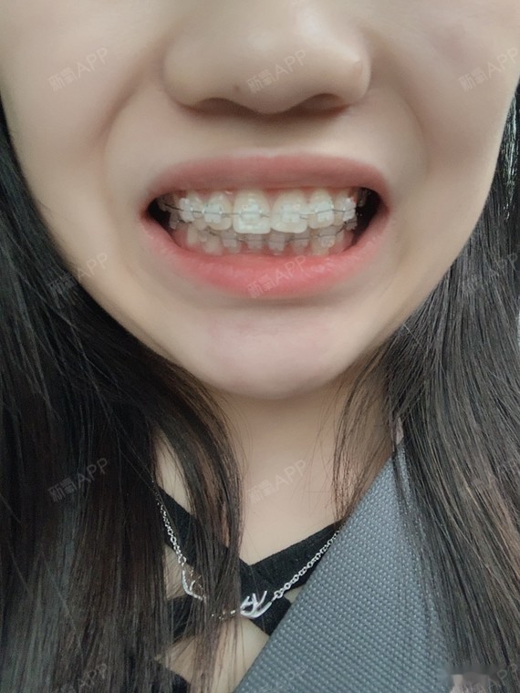 今天9-9 要死 我发现我的左边上面三号牙侧面好像_圈子-新氧美容整形