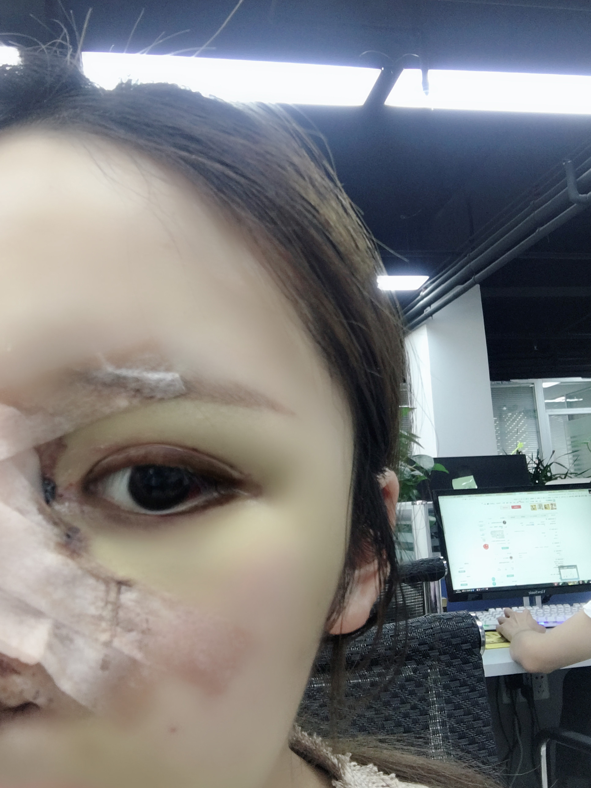 我发现眼睛的恢复真的是要比鼻子快诶,眼睛现在基本上已经不肿了,而且