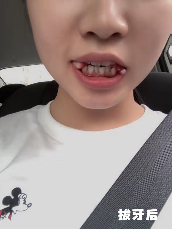 上牙凸起下牙凸,龅牙毁一生系列 牙性和骨性龅牙对比_圈子-新氧美容