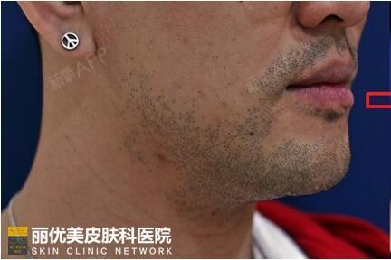 男性也需要护肤 胡子激光除毛 激光脱毛注意事项 大 圈子 新氧美容整形