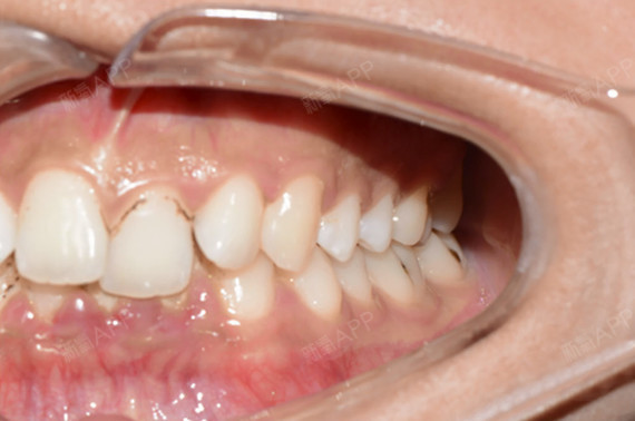 患者要求下颌多一颗牙齿影响美观要求拔除