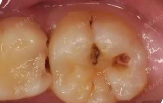 " 牙医却说:"这时病变已经破坏到牙本质浅层了,牙齿已经有龋洞形成,对