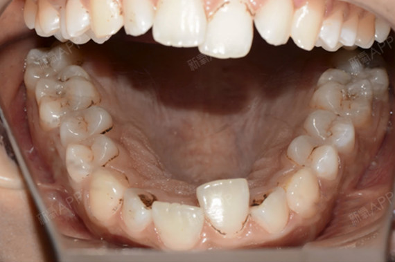 患者要求下颌多一颗牙齿影响美观要求拔除