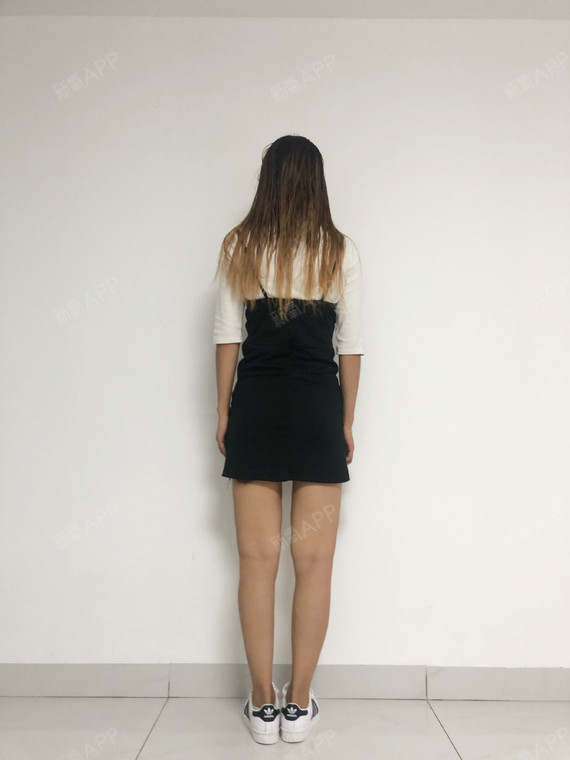 大腿吸脂,这个念头已经环绕我三四年了,从初中开始我_圈子-新氧美容