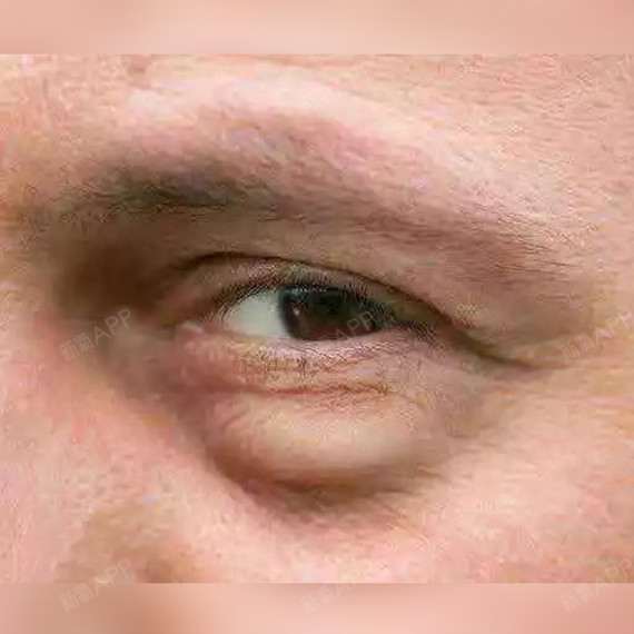 真性眼袋or假性眼袋,你真的分清楚了吗?