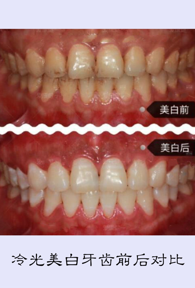 牙黄做冷光美白和贴面哪个好?
