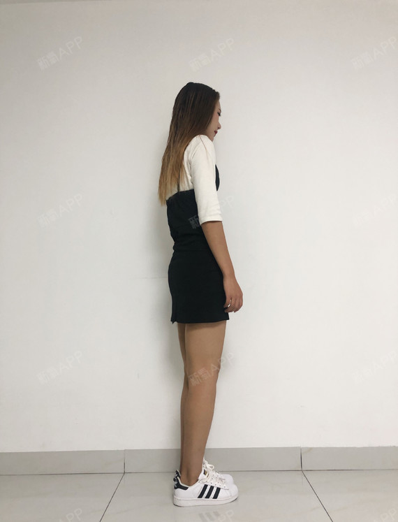 大腿吸脂,这个念头已经环绕我三四年了,从初中开始我_圈子-新氧美容