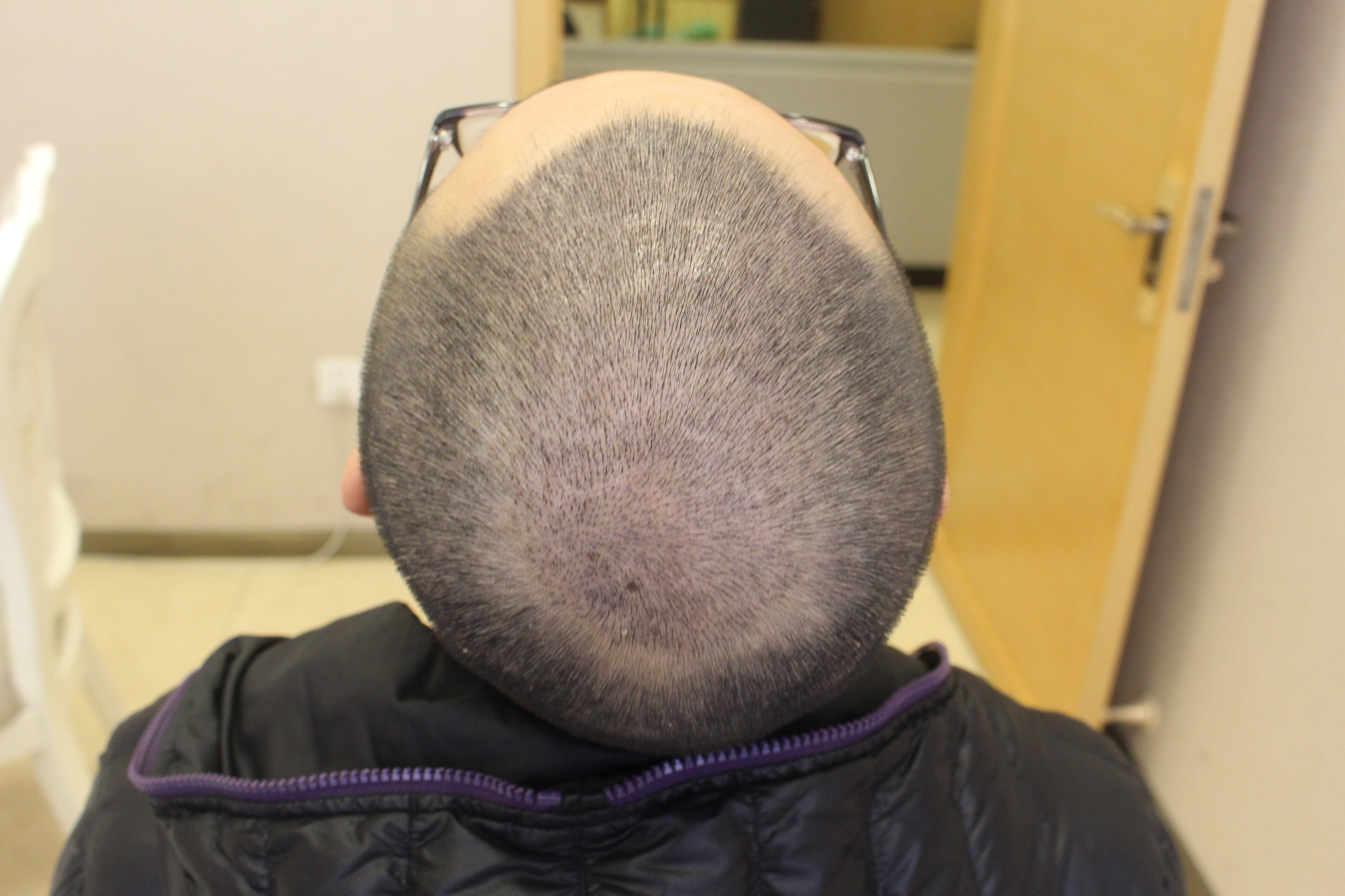 科发源(大麦)全球连锁微针植发种植发际线怎么样_恢复过程_效果如何