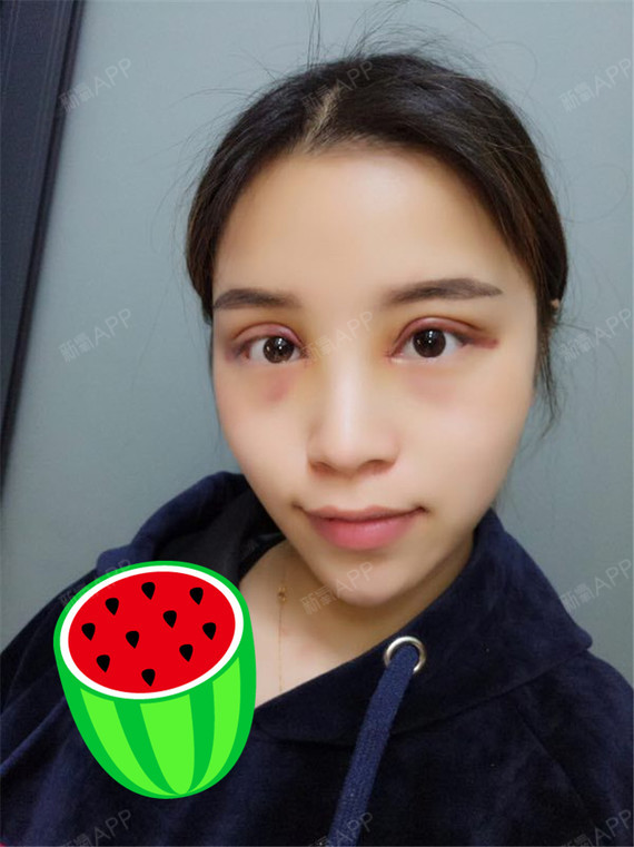 这是术后3天的照片,有明显的开内眼角的痕迹,除了稍_圈子-新氧美容