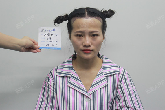 疤痕植发放心雍禾植发
