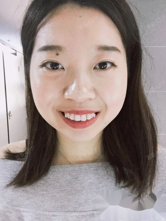 今天忽然发现,上牌有一颗飘出来的牙齿,已经不飘了,才带了5天