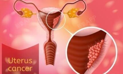 首页 此页面仅支持预览 Avatar 氧气0adir 467篇日记 半年内两次人流的危害有多大你必须要重视的健康问题半年内两次人流的危害有多大 半年内两次流产 属于高危流产 半年内两次人流的危害会增加宫腔黏连 宫颈黏连 慢性盆腔炎 月经不调 甚至激发性