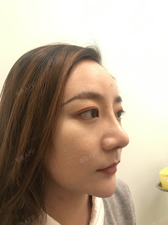 假体垫鼻基底