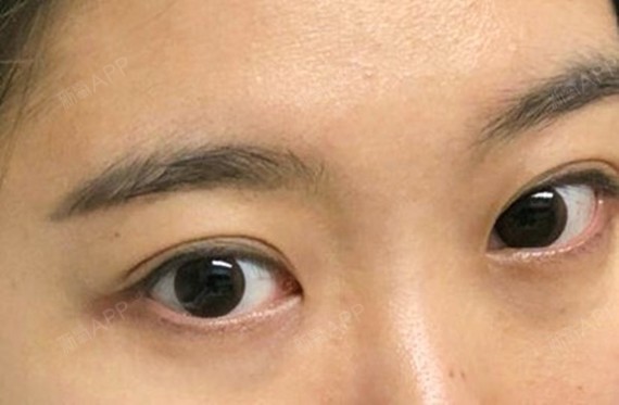 做了双眼皮自然粘连法,已经四个月了!