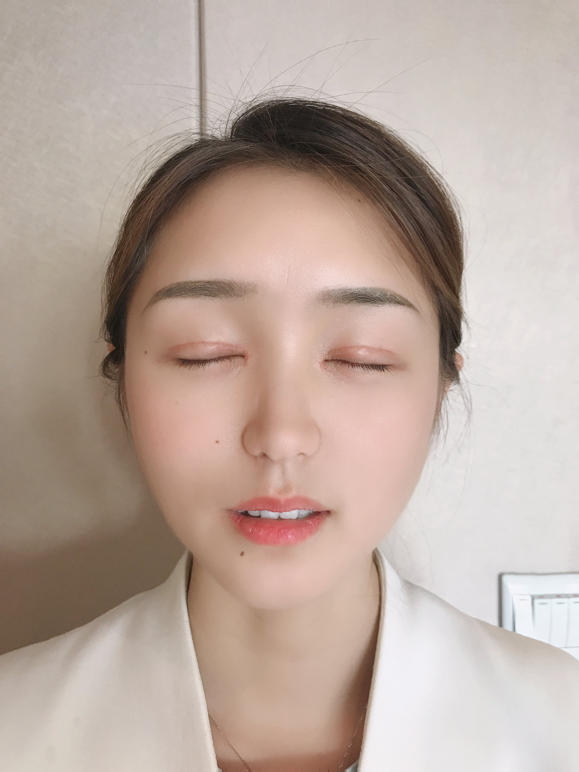 切开双眼皮怎么样_恢复过程_效果如何_氧气4544x整形日记10.