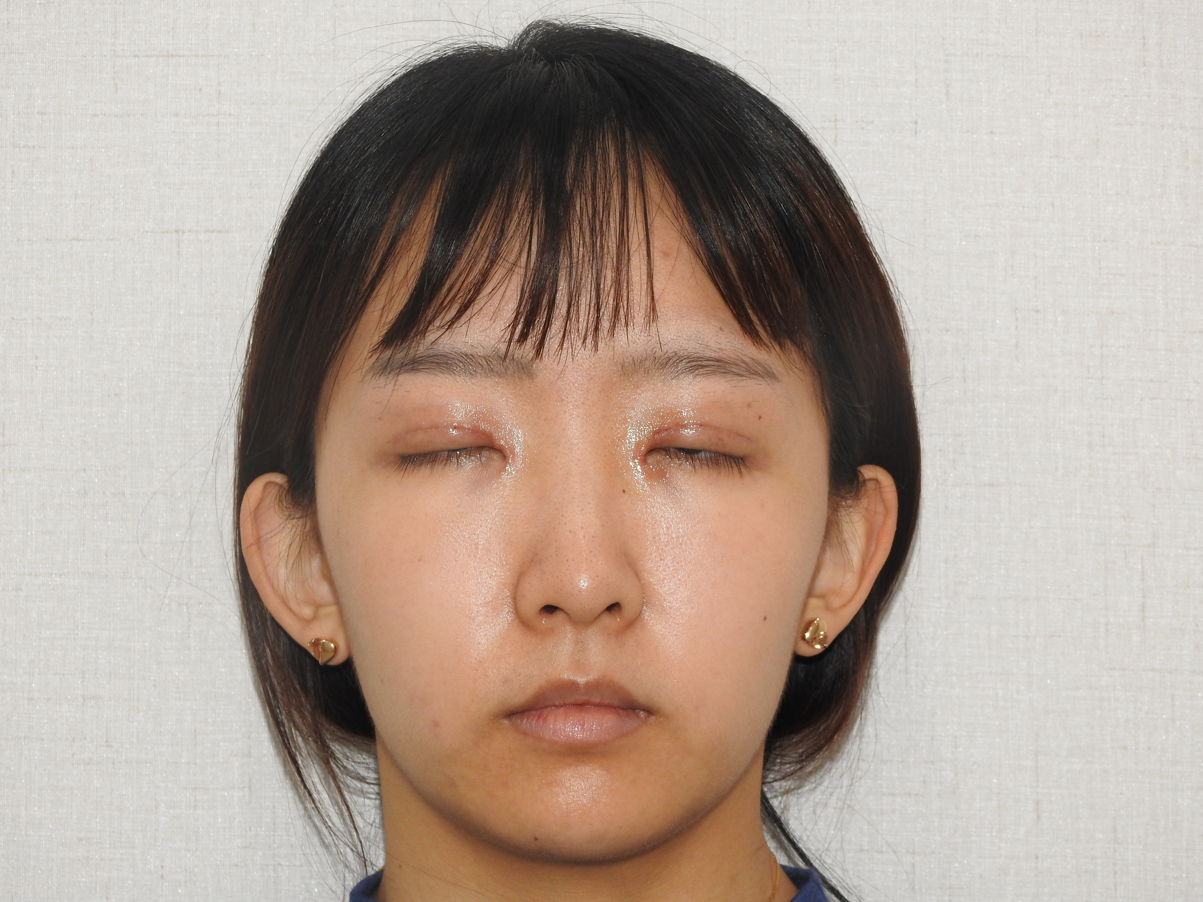 北京百达丽医疗美容门诊部眼部修复怎么样_恢复过程_效果如何_氧气2p