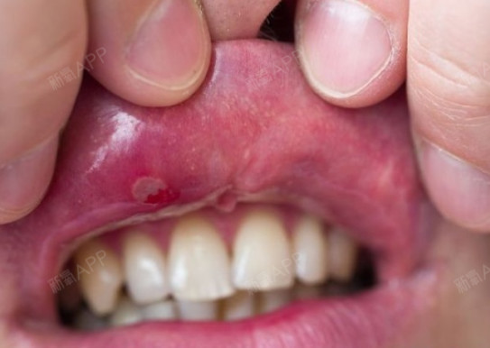 牙龈上长口腔溃疡图片