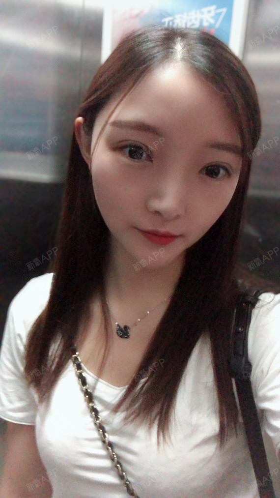 【温州艺星眼部多项】再过两天就满月了,还是希望恢复_圈子-新氧美容