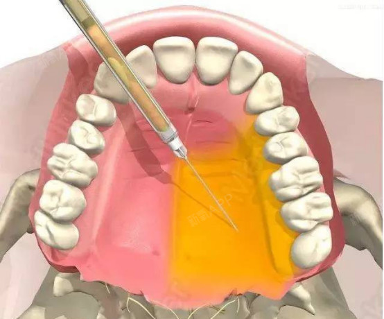 牙齿打麻药的位置图图片