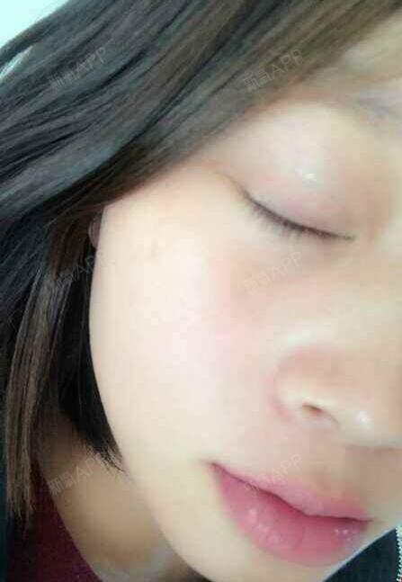 做的双眼皮,现在闭眼都看不到痕迹了,跟天生的一样自然