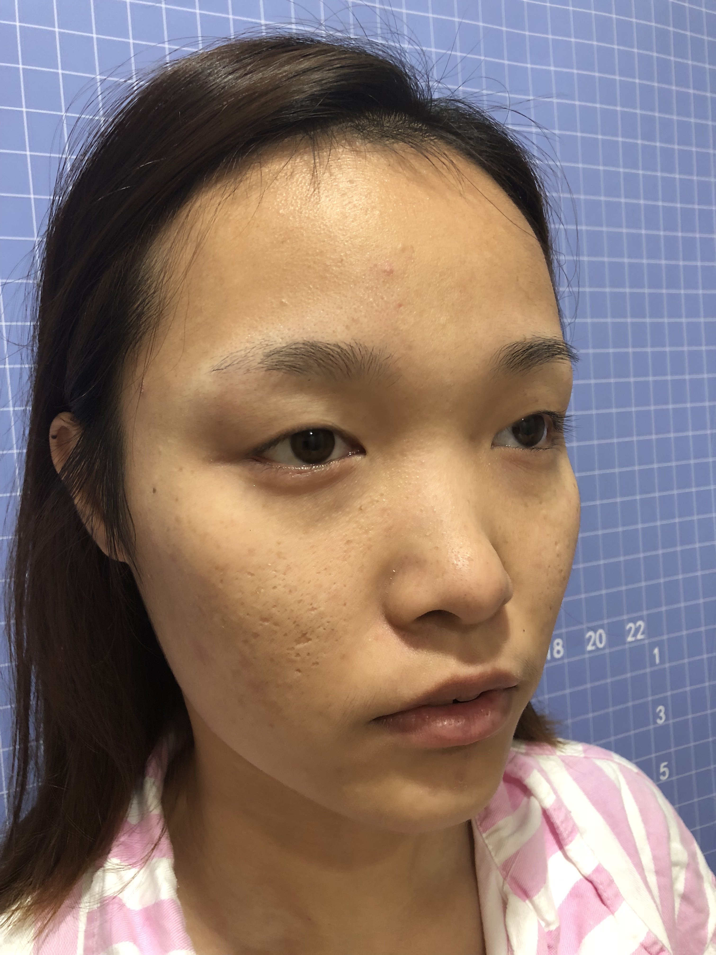 外切眼下至术后四十天右眼疤痕凹陷,可以恢复吗?这种疤痕修复有效吗?