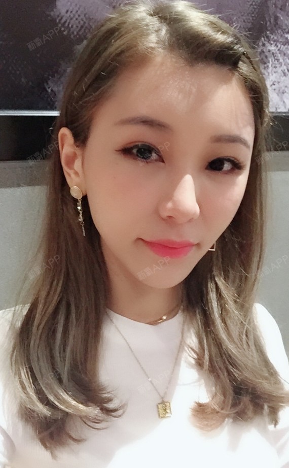 自体脂肪丰卧蚕好不好_效果图_伴梦长久咳自体脂肪丰卧蚕术后第7天