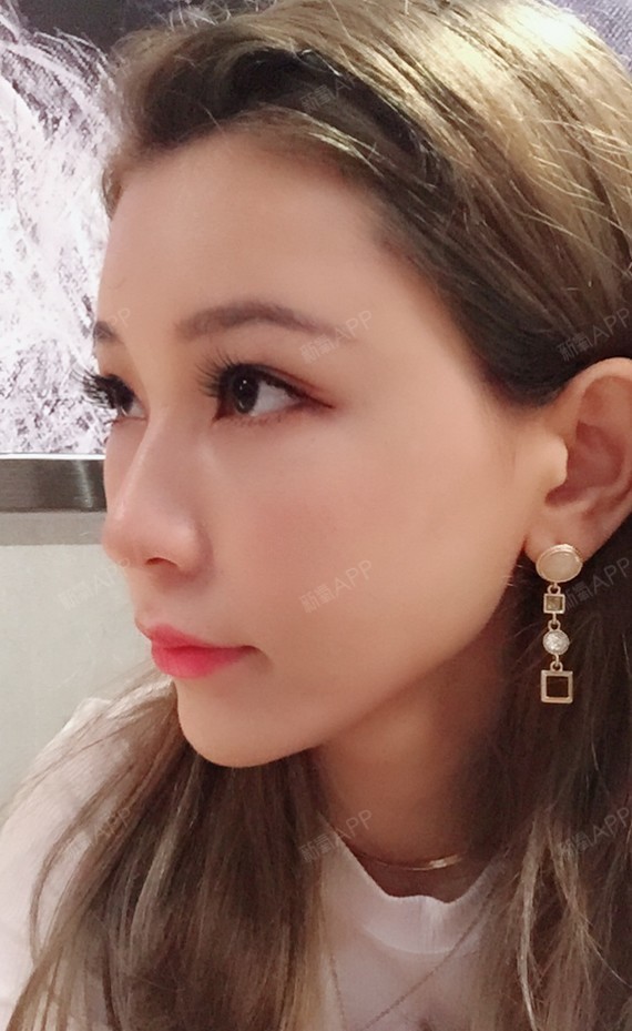 自体脂肪丰卧蚕好不好_效果图_伴梦长久咳自体脂肪丰卧蚕术后第7天