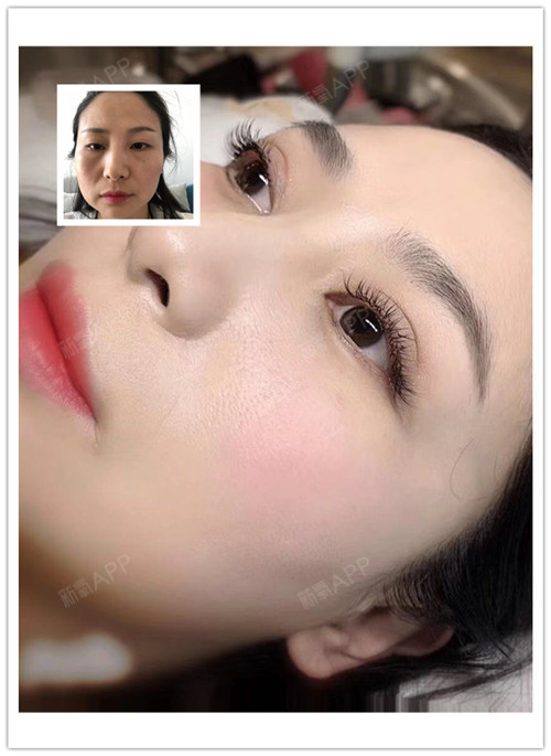 【苏州美莱双眼皮术后第45天】现在眼睛算恢复的很好_圈子-新氧美容