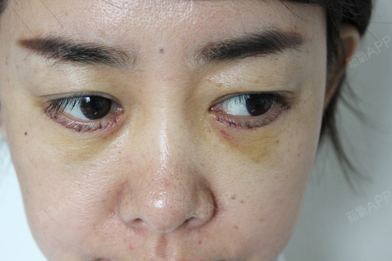 北京内切去眼袋好不好_效果图_涵树姐姐内切去眼袋术后第3天_新氧美容
