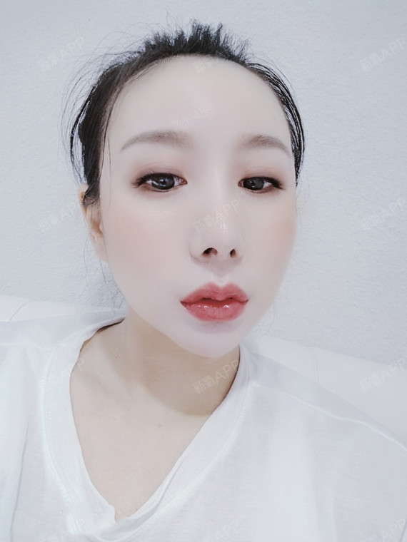 沈阳m唇手术好不好_效果图_氧气zcgchm唇手术术后第37天_新氧美容整形