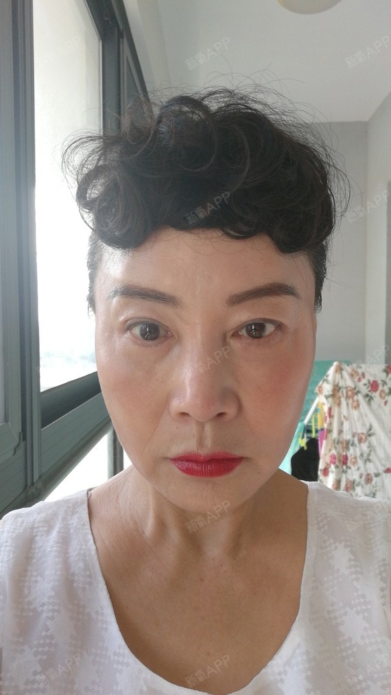 外切去眼袋好不好_效果图_mmy888外切去眼袋术后第165天_新氧美容整形